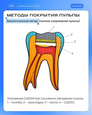 Прямое и непрямое покрытие пульпы: схемы в помощь.